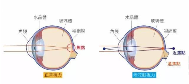 白內(nèi)障和老花眼區(qū)別，老花眼發(fā)病率正呈現(xiàn)年輕化趨勢