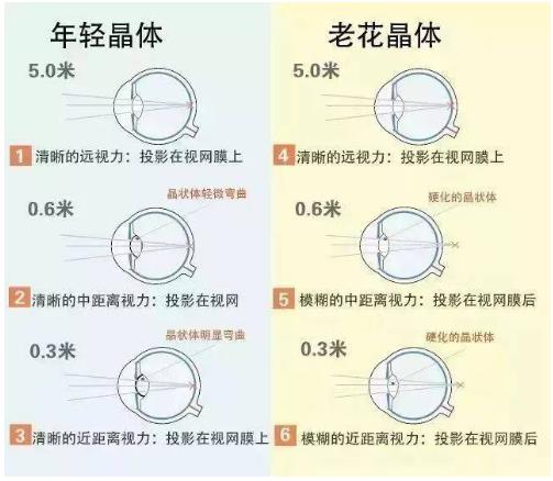 近視就不會老花了嗎？